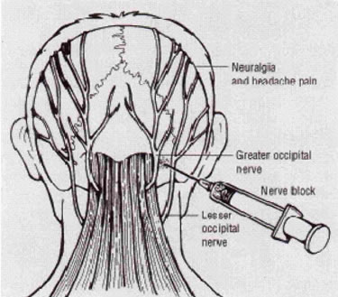 Location and demonstration of a greater occipital nerve block 